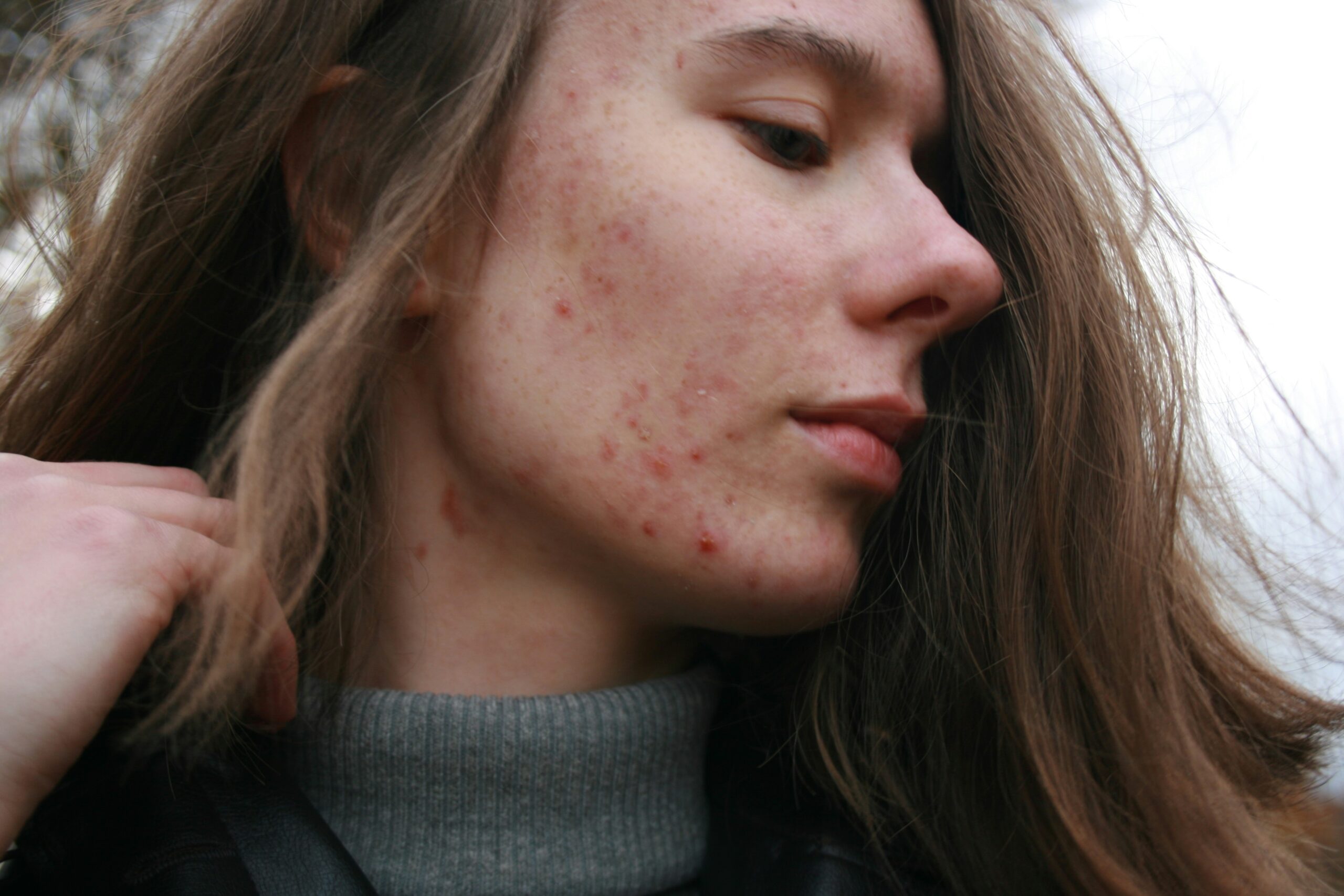 Why Your Skin Won’t Clear Up: The Gut Connection You Need to Know
