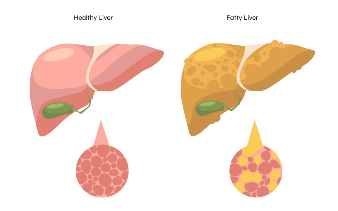 Why Is Fatty Liver Increasing Among Young Adults?