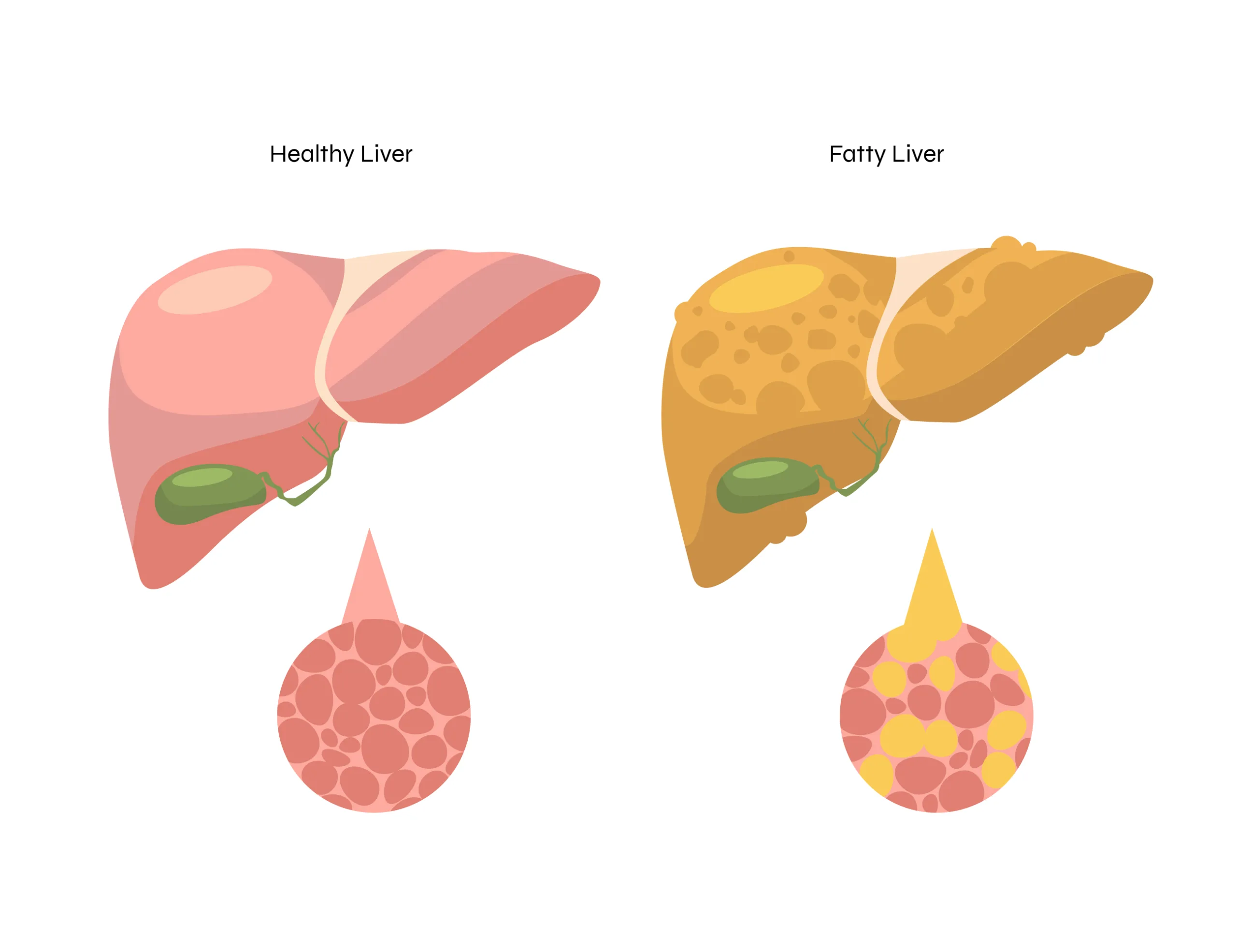 Why Is Fatty Liver Increasing Among Young Adults?